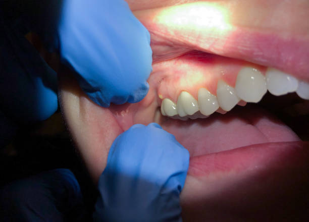 Best Emergency Denture Repair in Southwood Acres, CT